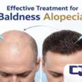 Advanced Baldness Alopecia Treatment With QR678 Therapy