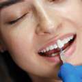 Are Veneers Permanent? What You Should Know