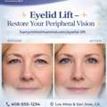 Eyelid Lift In Los Altos And San Jose CA Improves Vision Naturally