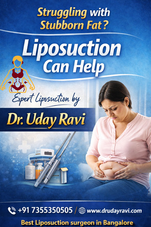 Bangalore, Health, Best Liposuction Surgeon In Bangalore - Dr.Uday Ravi, Yelahanka