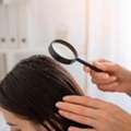 Best Hair Loss Treatment In India | QR678