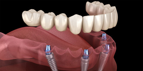 London, Dental, Advanced Dental Implants Windsor For Natural Looking Smiles
