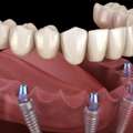 Advanced Dental Implants Windsor For Natural Looking Smiles