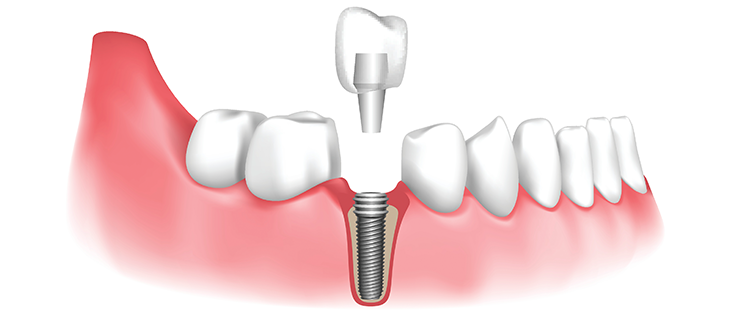 London, Dental, Reliable Dental Implants Maidenhead For Long Lasting Results