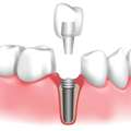 Reliable Dental Implants Maidenhead For Long Lasting Results