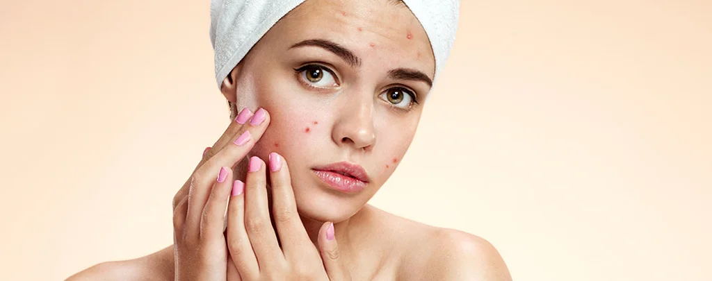 Ahmedabad, Business, Acne Treatment In Ahmedabad | Advanced Skin Care At Rejuva Aesthetica