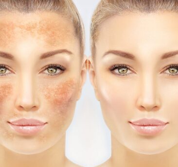 Sydney, Beautician, Is Pigmentation Treatment Malvern Right For You?