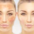 Is Pigmentation Treatment Malvern Right For You?