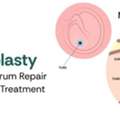 Myringoplasty Surgery For Eardrum Repair &ndash; Safe & Effective Treatment