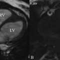 Same Day Reports - Cardiac MRI Scan In Mumbai By Picture This