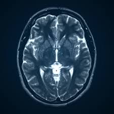 London, Health, Why Is Magnetic Resonance Imaging Of The Brain Important For Early Diagnosis?