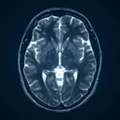 Why Is Magnetic Resonance Imaging Of The Brain Important For Early Diagnosis?