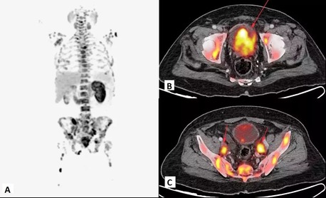 Mumbai, Medical, Precision Cancer Detection With Advanced FAPI PET-CT At Picture This Mumbai