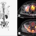 Precision Cancer Detection With Advanced FAPI PET-CT At Picture This Mumbai
