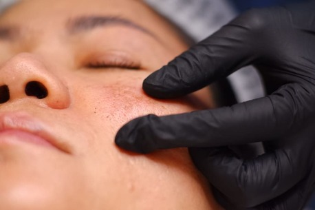 Dubai, Beautician, Professional Solutions For Melasma Treatment And Dark Spot Removal In Dubai