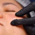 Professional Solutions For Melasma Treatment And Dark Spot Removal In Dubai