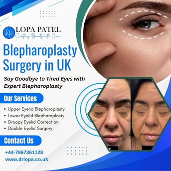 London, Health, Blepharoplasty Surgery In UK By Dr Lopa Patel