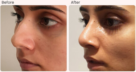 New Delhi, Health, Rhinoplasty Surgery In Delhi - Dr Rajat Gupta