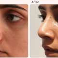 Rhinoplasty Surgery In Delhi - Dr Rajat Gupta