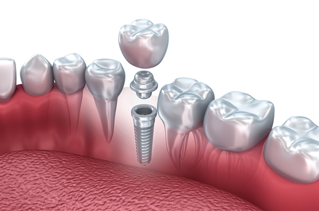 Lucknow, Health, Dental Implants Periodontist In Noida &ndash; The Dental Port