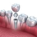 Dental Implants Periodontist In Noida &ndash; The Dental Port