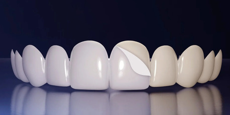 New Delhi, Health, Teeth Whitening In Dwarka Delhi & Its Cost In Delhi At Samadhan Clinic