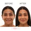 Enhance Your Look With Lip Fillers In Aventura, FL &ndash; Book Today!