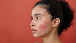 New York, Health, Oil-Balancing Treatment For Shiny, Acne-Prone Skin