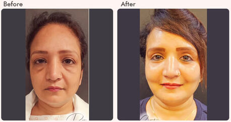 New Delhi, Health, Eyelid Surgery In Delhi - Dr Rajat Gupta
