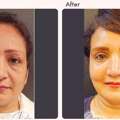 Eyelid Surgery In Delhi - Dr Rajat Gupta