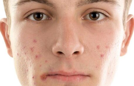 New York, Health, Targeted Care For Post-Acne Marks