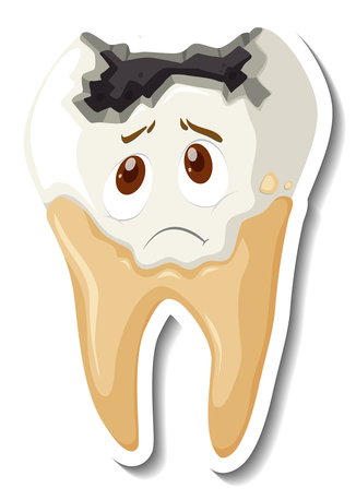 Mumbai, Health, Understanding Tooth Decay: Causes, Symptoms, And Prevention