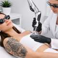 Laser Tattoo Removal In Dubai: Procedure, Results, And Expert Advice