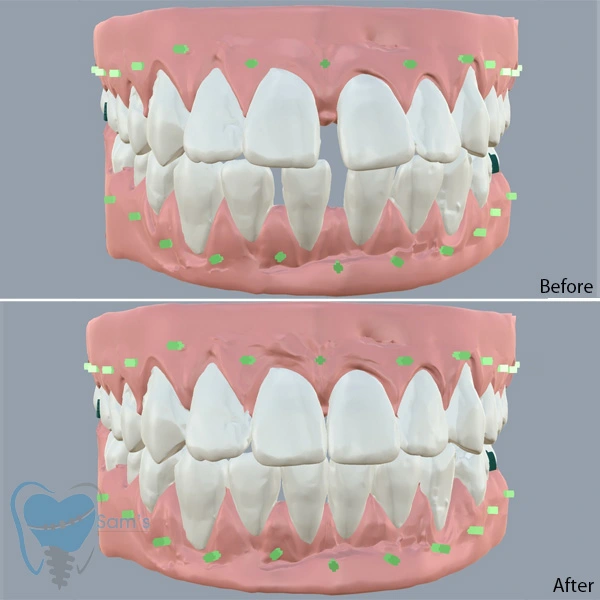 Chennai, Dental, Gap Teeth Braces Aligners Treatments In Tamilnadu