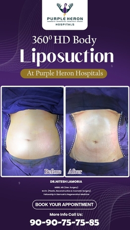 Jaipur, Health, Best Liposuction Surgeon In Jaipur - Dr. Nitesh Lamoria