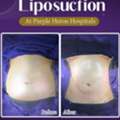 Best Liposuction Surgeon In Jaipur - Dr. Nitesh Lamoria