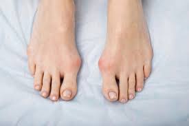 Singapore, Health, 5 Key Stages Of Bunion Surgery Recovery You Should Know