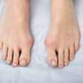 5 Key Stages Of Bunion Surgery Recovery You Should Know