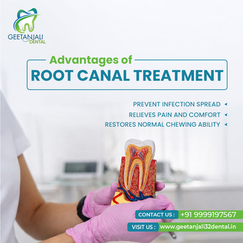 Ghaziabad, Dental, Root Canal Treatment In Gaur City For Safe Tooth Care