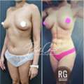Top-Rated Liposuction Surgeons With Patient Reviews: What You Should Really Look For