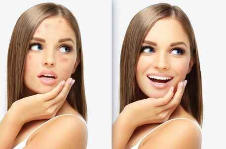 Dubai, Beautician, Acne Vs Acne Scars: Finding The Right Treatment For Clearer Skin