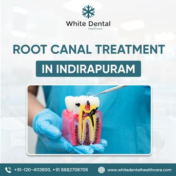 Ghaziabad, Health, Best Root Canal Treatment In Indirapuram