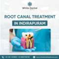 Best Root Canal Treatment In Indirapuram