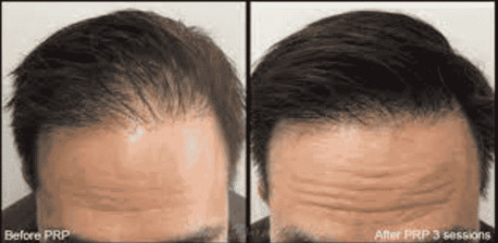 New York, Health, Hair Loss Treatment NYC