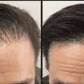 Hair Loss Treatment NYC