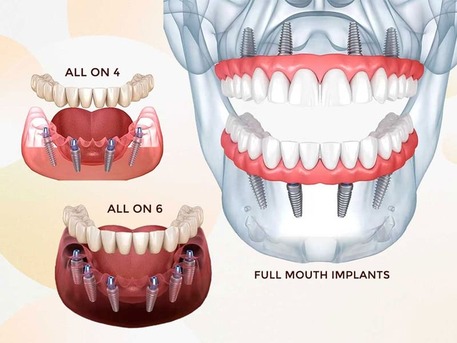 New Delhi, Dental, Dental Implants In Delhi NCR