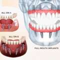 Dental Implants In Delhi NCR