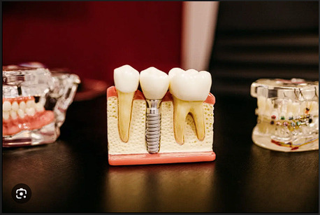 New York, Dental, Long Lasting Dental Implants In Chandler For Missing Teeth