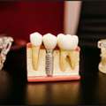 Long Lasting Dental Implants In Chandler For Missing Teeth