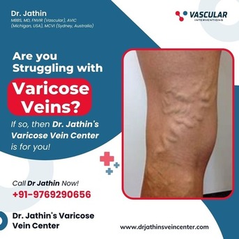 Mumbai, Health, Personalized Vein Treatment For Effective & Lasting Results